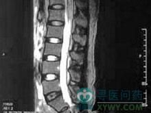 亞急性壞死性脊髓炎 亞急性壞死性脊髓炎