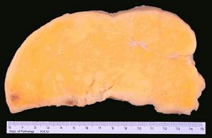原發性肝脂肪肉瘤