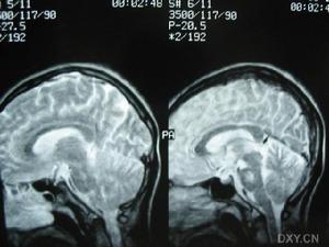 原發性直立性低血壓