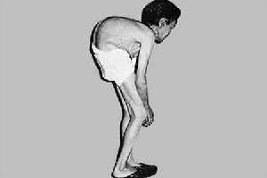 骨痛病與鎘中毒