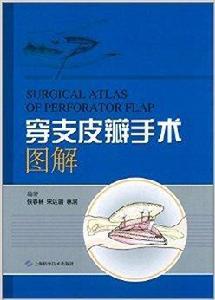 穿支皮瓣手術圖解 穿支皮瓣手術圖解