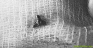 外星人植入物 外星人植入物