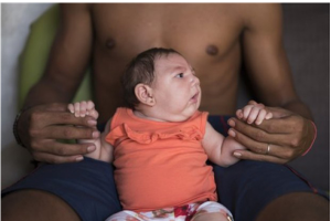 世界衛生組織聲稱茲卡病毒會導致新生兒患“小頭畸形症”。