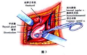 膈上憩室 膈上憩室
