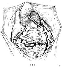 冠狀動脈異位起源