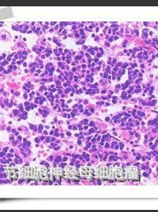 神經母細胞瘤 神經母細胞瘤