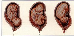 前置胎盤