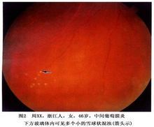 中間葡萄膜炎 中間葡萄膜炎