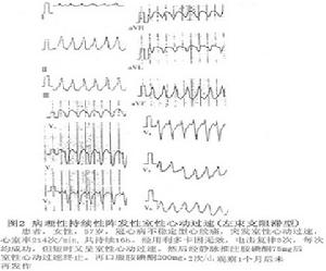 病理性陣發性室性心動過速