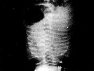 新生兒呼吸暫停