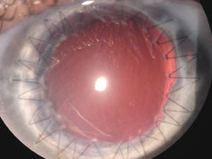 骨齒人工角膜手術 骨齒人工角膜手術