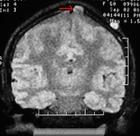 顱骨良性腫瘤 顱骨良性腫瘤