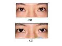 眼袋抽脂 眼袋抽脂