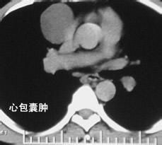 心包囊腫與心包憩室 心包囊腫與心包憩室