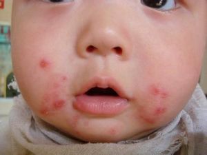 深膿皰病 深膿皰病