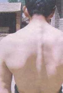 強直性肌營養不良