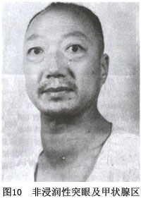 毒性瀰漫性甲狀腺腫