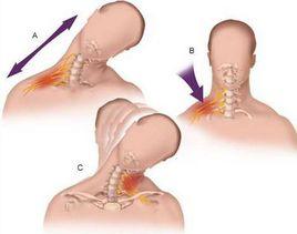 臂叢損傷 臂叢損傷