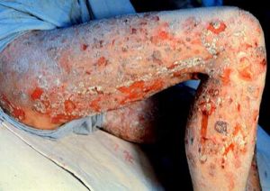 天皰瘡病 天皰瘡病