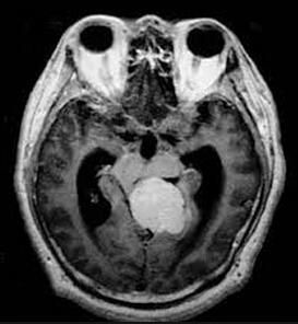 嗅溝腦膜瘤 嗅溝腦膜瘤