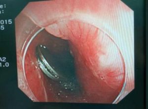 胃內異物 胃內異物