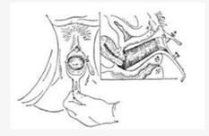 處女膜肥厚 處女膜肥厚