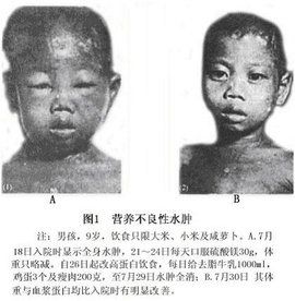 蛋白質營養不良 蛋白質營養不良