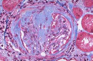 局灶性節段性腎小球硬化