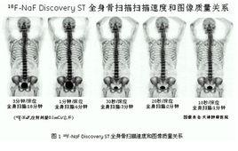 全身骨掃描 全身骨掃描