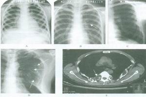多骨纖維發育不良