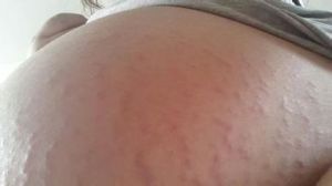 孕婦濕疹 孕婦濕疹