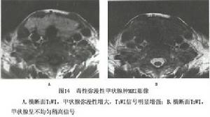 毒性瀰漫性甲狀腺腫