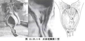 後尿道瓣膜 後尿道瓣膜