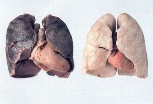 煙肺與健康的肺