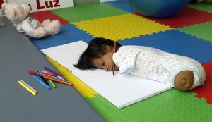 先天性四肢切斷綜合症 先天性四肢切斷綜合症