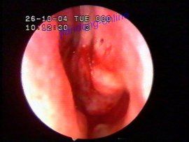 鼻甲肥大 鼻甲肥大