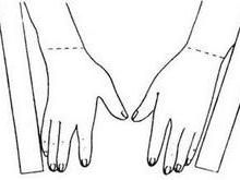 柯萊斯骨折 柯萊斯骨折