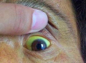 眼白髮黃 眼白髮黃