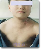 何杰金氏淋巴瘤