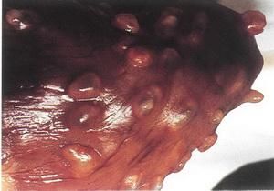 豬帶絛蟲病 豬帶絛蟲病