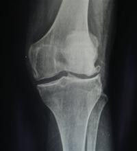 膝關節退行性關節炎