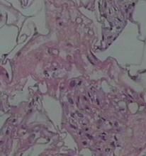 類固醇後脂膜炎 類固醇後脂膜炎