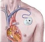 酒精性心臟病 酒精性心臟病