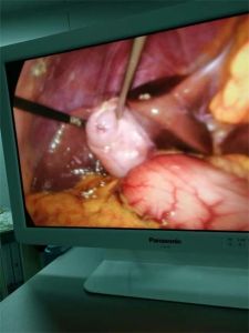 超微保膽取石術 超微保膽取石術