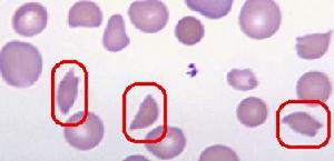 血栓性血小板減少性紫癜