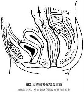盆底腹膜疝 圖2