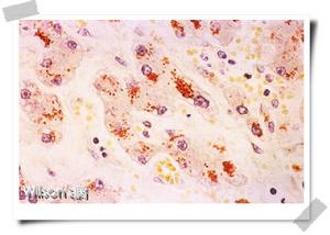 wilson's病wilson's disease...