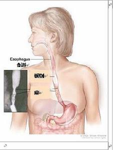 吻合口瘺 吻合口瘺