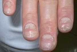 嵌甲性甲溝炎 嵌甲性甲溝炎