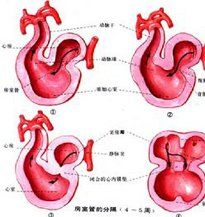 左心室肥大 左心室肥大